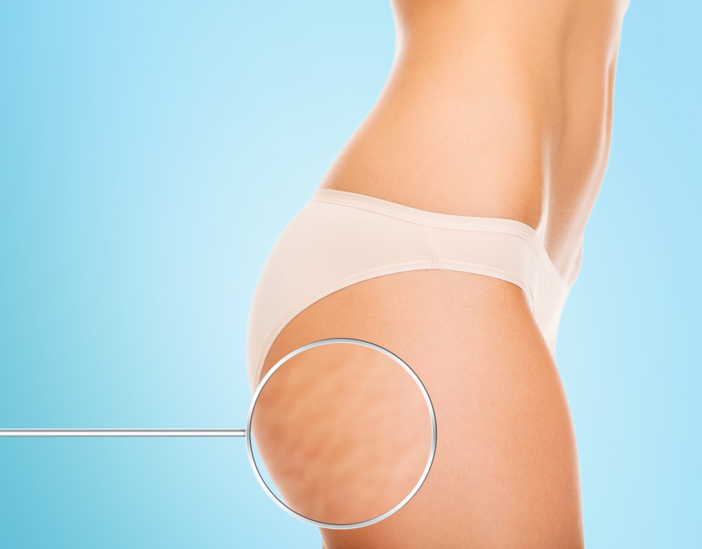 Best Treatment for Cellulite