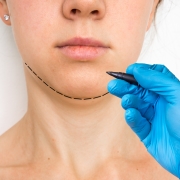 CoolSculpting for the Chin