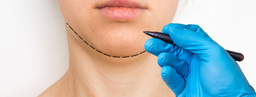 CoolSculpting for the Chin